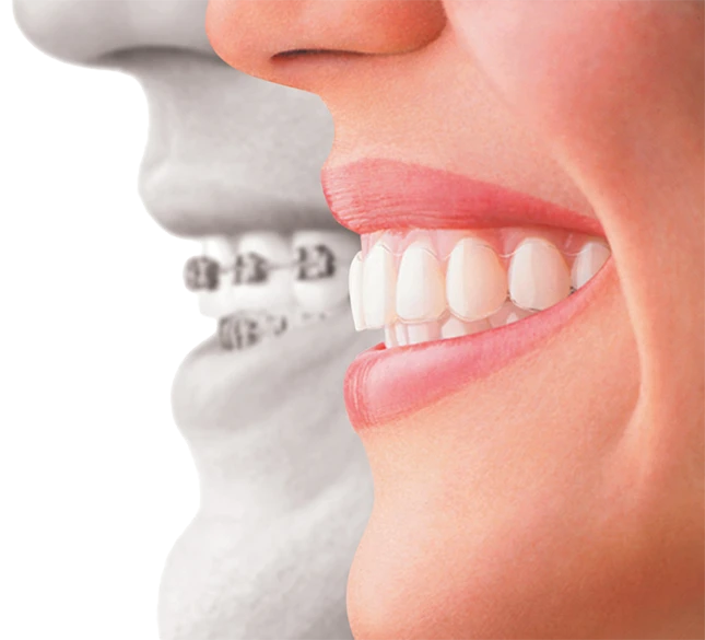 Vergleich von Brackets zu Invisalign-Alignern